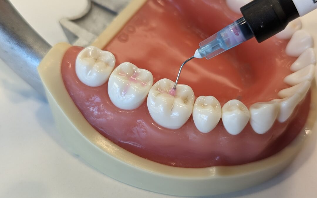 What Are Dental Sealants and Does My Child Need Them?