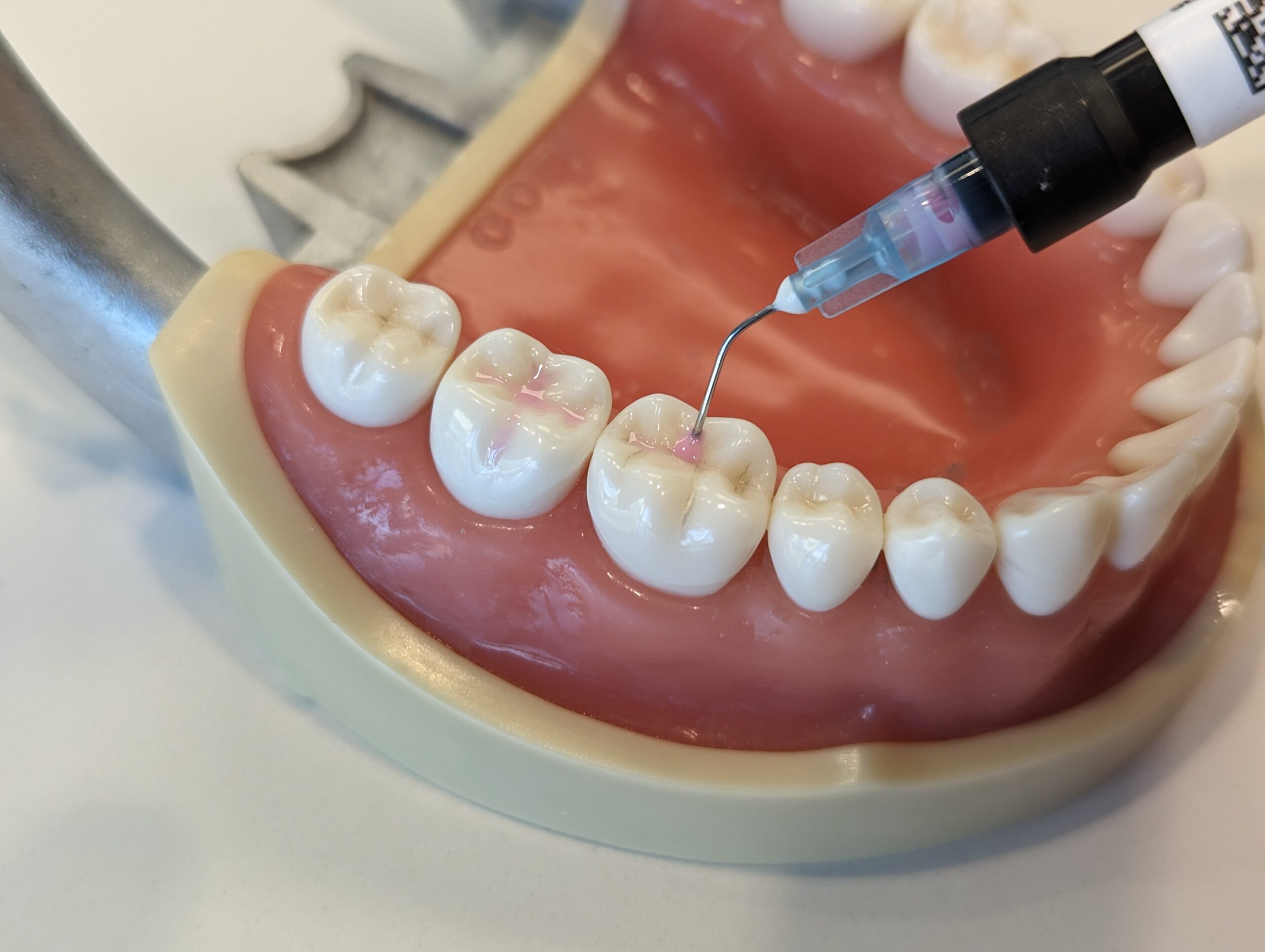 dental-sealants-round-rock dental sealants